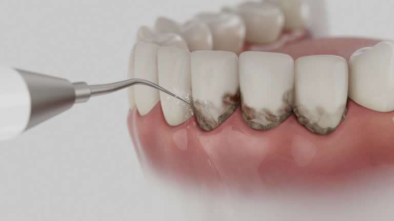 Trusted Wisdom Tooth Removal service in Greenfield, IL - Dentist Open Now